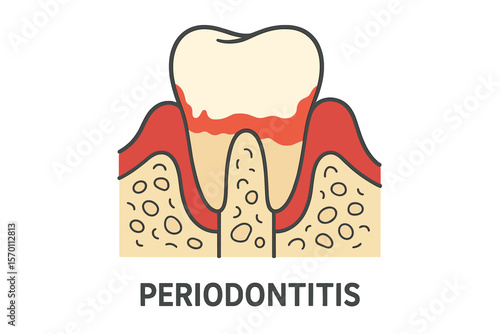 Periodontitis is an inflammation of the gums, as shown in a detailed illustration