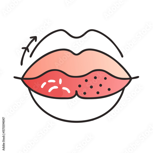 Illustration of irritated lips with dryness and skin peeling