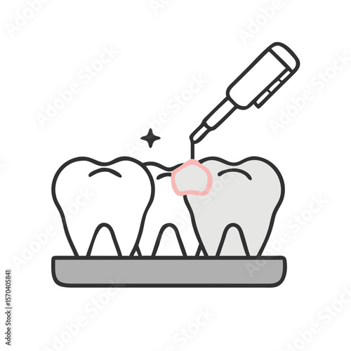 Dental procedure illustration depicting filling placement on a tooth