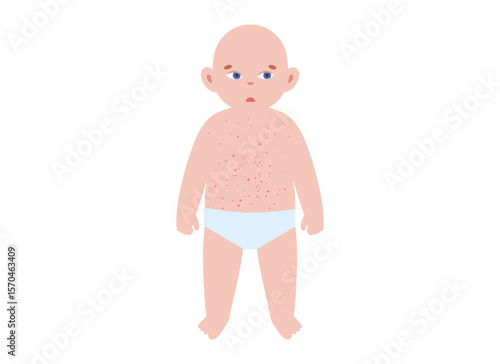 The most common viral rashes