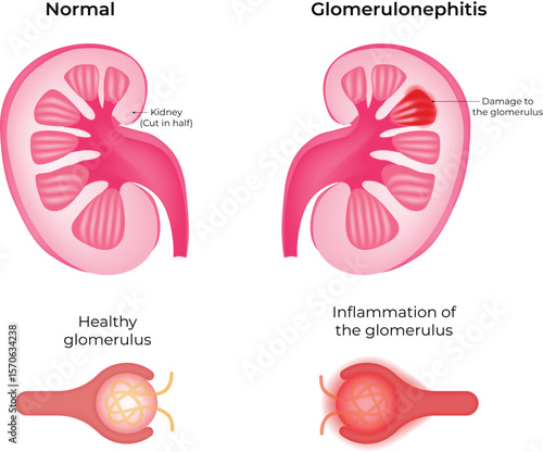 Normal Kidney vs Glomerulonephritis A Comparative Illustration