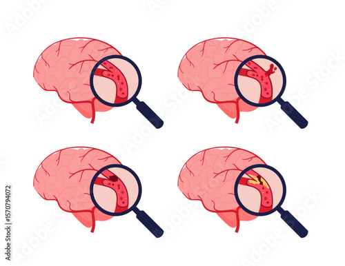 Brain neural disease for healthcare infographic. Vector flat illustration. Atherosclerosis, ischemic, hemorrhagic strokes. Side view blood vessel and brain. Design for health care, education