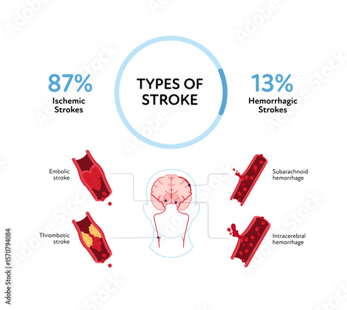 Brain neural disease for healthcare infographic. Vector flat illustration. Embolic, thrombotic, subarachnoid and intracerebral hemorrhage stroke with probability in percent. Design for health care