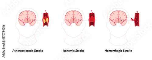Brain neural disease for healthcare infographic. Vector flat illustration. Atherosclerosis, ischemic, hemorrhagic strokes. Brain front view with vessel, blood clot. Design for health care, education