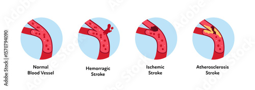 Brain neural disease for healthcare infographic. Vector flat illustration. Atherosclerosis, ischemic, hemorrhagic strokes. Side view blood vessel. Design for health care, education