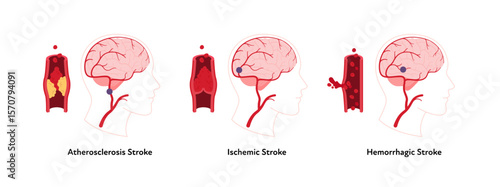 Brain neural disease for healthcare infographic. Vector flat illustration. Atherosclerosis, ischemic, hemorrhagic strokes. Brain side view with vessel, blood clot. Design for health care, education