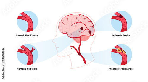Brain neural disease for healthcare infographic. Vector flat illustration. Atherosclerosis, ischemic, hemorrhagic strokes. Brain side view with normal and ill vessel. Design for health care, education