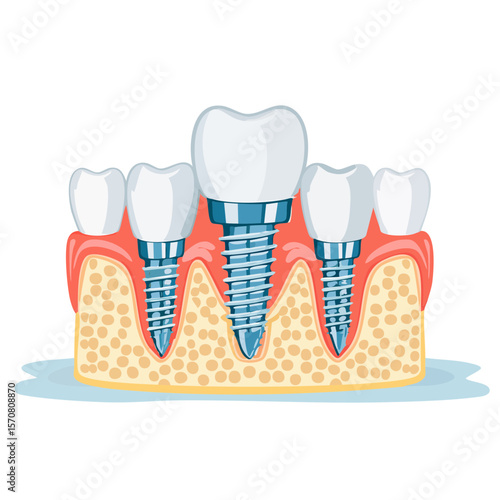 Dental Implant Illustration with Teeth and Bone Structure