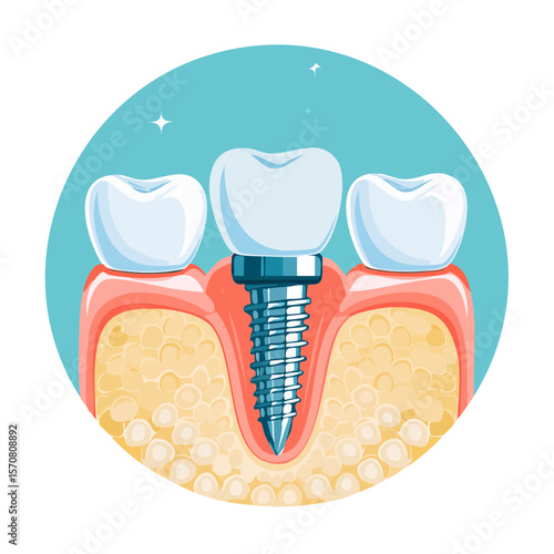 Dental Implant Illustration: Tooth Replacement and Oral Health