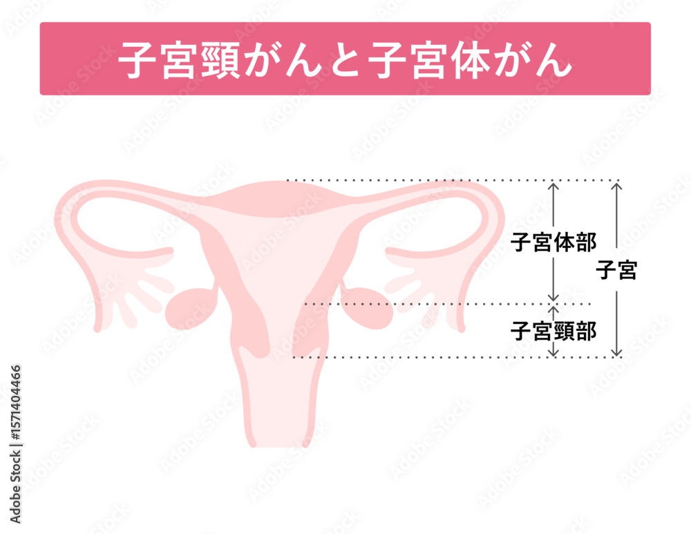 Obraz premium 子宮頸がんと子宮体がん