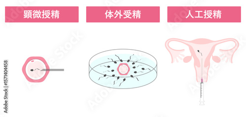 顕微授精_体外受精_人工授精