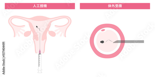 人工授精と体外受精