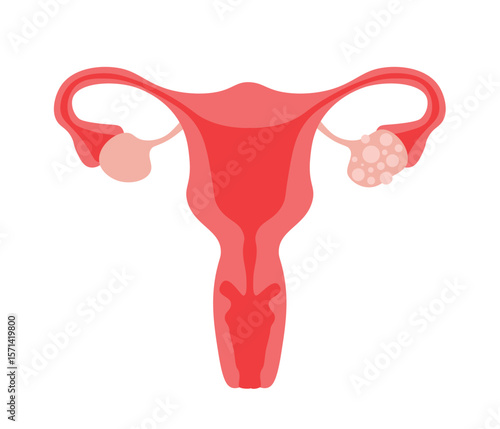 Polycystic ovarian syndrome. Uterus, infertility, gynecology.