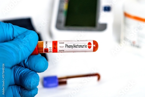 Phenylketonuria - Test with blood sample on shiny blue hand. health or medical concept