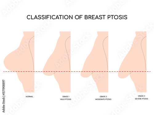 Breast fat transfer lift asymmetrical nipple sag rejuvenate surgery.Sag ptosis correction rejuvenate of breast surgery implantation