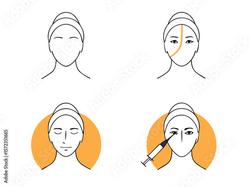 Illustrated stages of cosmetic injectable treatments showing procedures on human face