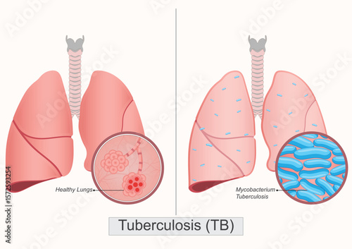 Tuberculosis (TB) is a potentially serious infectious disease.
