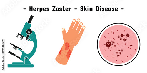 Exposure design of herpes zoster skin disease on the hand and illustration of microscope and virus.