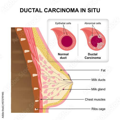 Ductal Carcinoma in Situ illustration