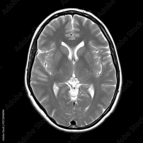 Axial T2-weighted brain MRI of a 40-year-old showing normal anatomy of lateral ventricles, thalamus, and basal ganglia without visible pathology.