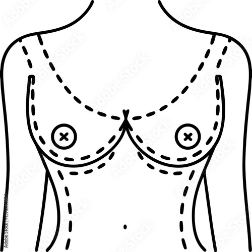 Breast lift illustration showing incision lines for surgical procedure. Breast augmentation with guide lines demonstrates surgical options, breast lift is often done for aesthetic reasons.