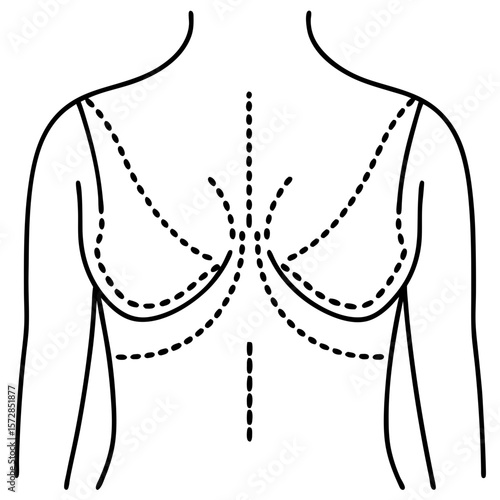 Breast with incision lines depicted in diagram showing surgical areas, including breast with incision lines, post operative. Breast with incision lines are shown for medical or educational purposes,