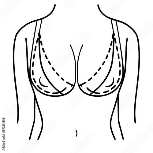 Breast with incision lines displayed in a simple diagram illustrating postoperative recovery and care. Breast with incision lines depicted for medical information and educational purposes.