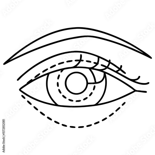 Eye area with surgical markings indicated as dashed lines, ideal for showing a blepharoplasty procedure. Eye area, surgical markings show potential incisions for cosmetic surgery.