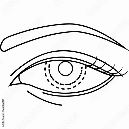 Eye area with surgical markings indicates blepharoplasty preparation, presenting upper eyelid dotted line before operation. Eye area is sketched to display procedure plan,