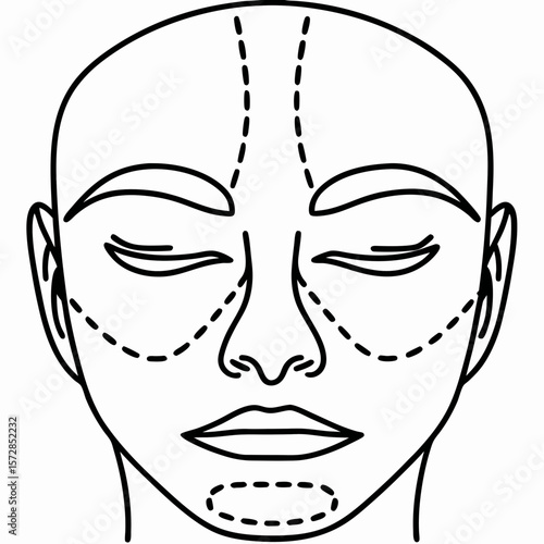 Face with surgical markings indicating plastic surgery areas, shown in black and white outline. Face with surgical markings shows potential incision sites.