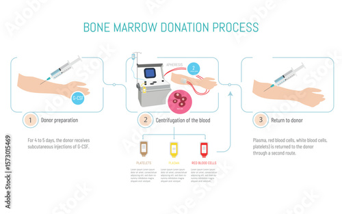 Bone marrow donation process explained with medical diagram