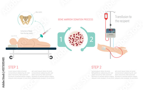 Bone marrow donation process showing extraction and transfusion