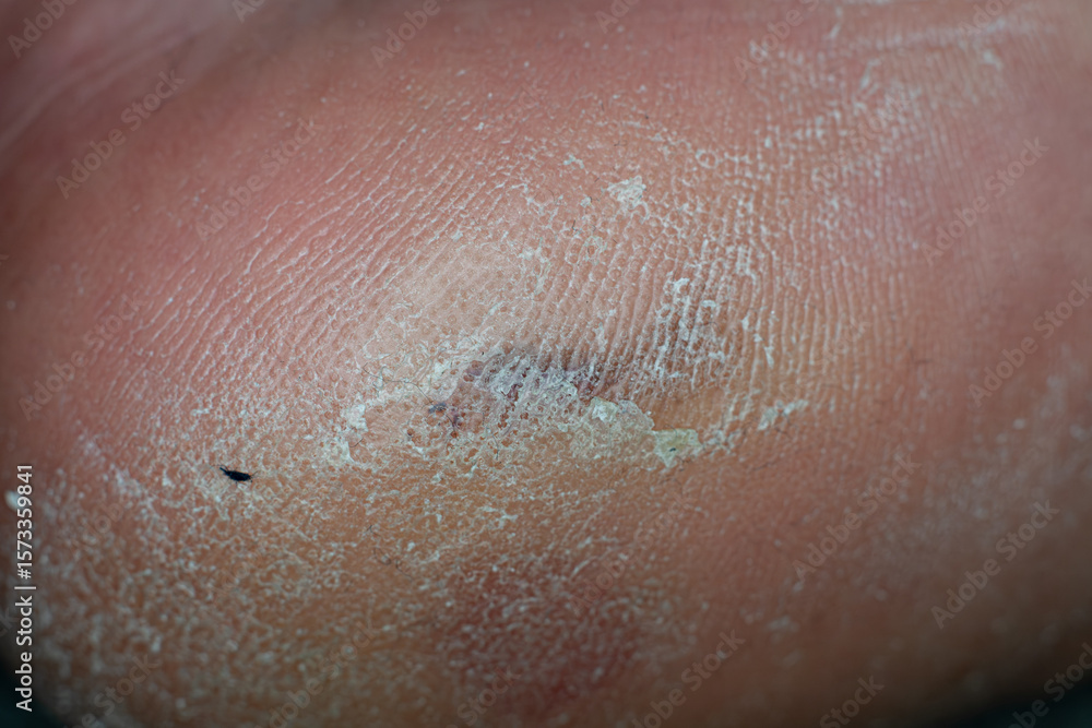 Fototapeta premium Dry skin on a heal of a foot