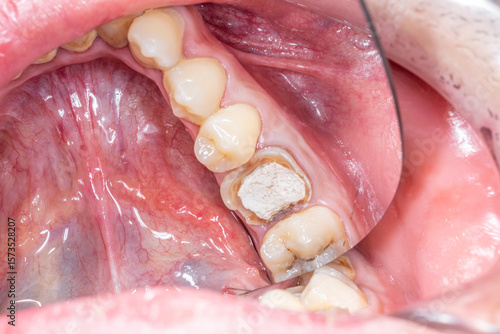 Directly above mirror view of a mandibular arch part with decayed molar crown completely destroyed and damaged with remaining structure sealed with a temporary white cement  to protect the root canals