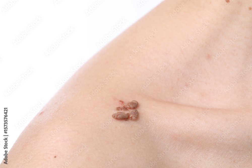 Obraz premium Woman with moles on her body against white background, closeup