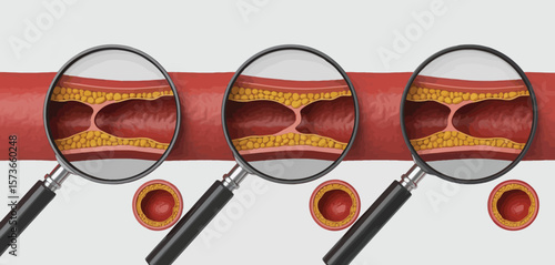 Stages of Arterial Plaque Buildup in Blood Vessels