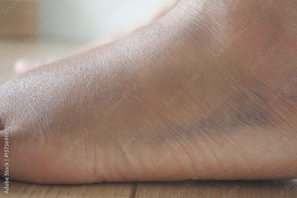 Fototapeta premium close up of women feet with swelling