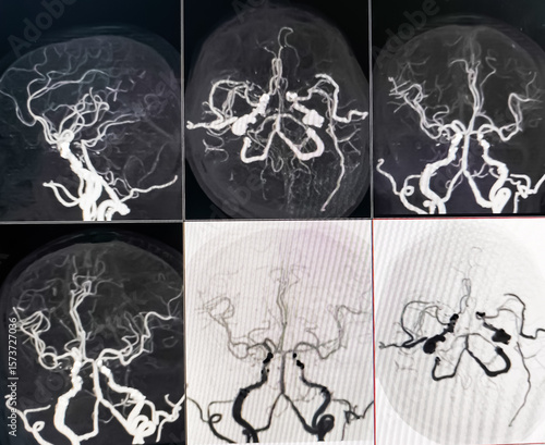 MRI of brain and MRA. CT Angiogram Brain showing anterior communicatting artery small dilatation, saccular aneurism. Hypoplasia of A1 segment. Cerebral atrophy.