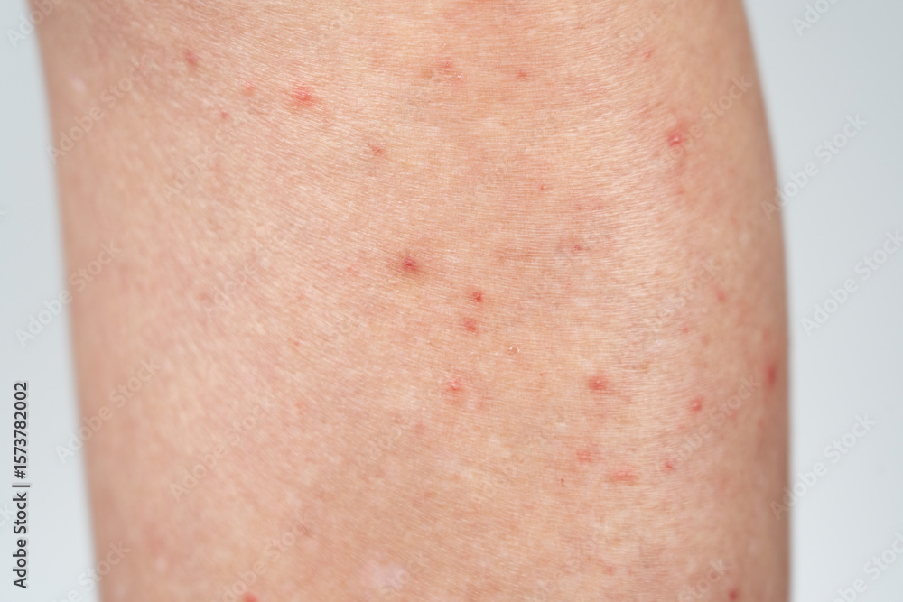 Fototapeta premium Closeup of dermatitis on skin 
