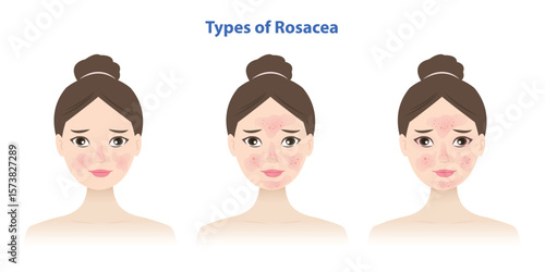 Types of rosacea on women face illustration. Erythematotelangiectatic, Papulopustular, Phymatous, Ocular rosacea causes redness, pimples on the cheeks, nose, chin, forehead, affects the eyes, eyelids.