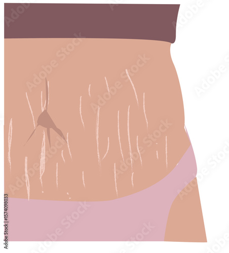 stomach stretch marks. Belly with stretch marks, Saggy skin removal