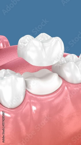 Preparated molar tooth and dental crown placement. Dental 3D animation