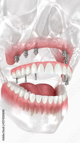 Dental prosthesis based on six implants. Dental 3D animation