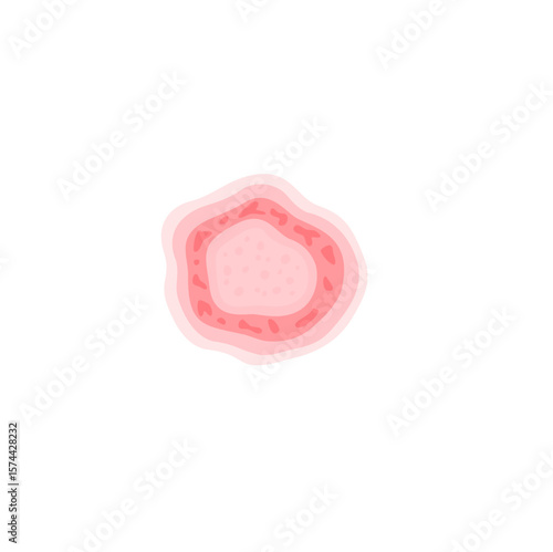 Dermatophytosis illustration