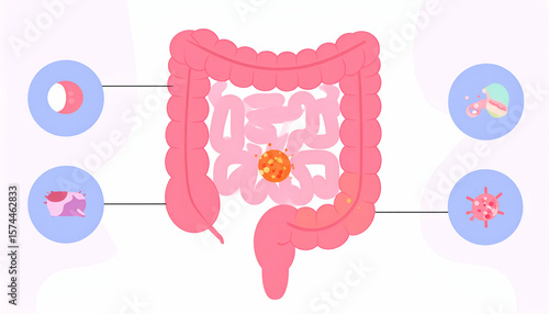 Colon Cancer Illustration Diagram.