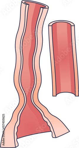 Anatomical illustration of the esophagus, the swallowing passage. A cross-section shows peristalsis and a potential stricture, compared to a normal, healthy esophageal section.