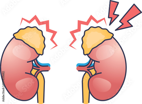 An illustration of stressed adrenal glands atop kidneys. Red lightning bolts symbolize adrenal fatigue, high cortisol, and the body's stress response, representing an adrenal surge.