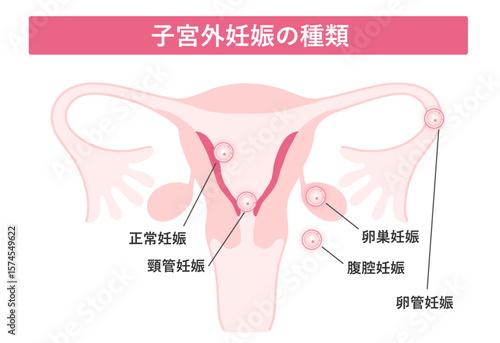 子宮外妊娠の種類