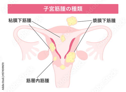 子宮筋腫の種類