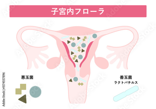 子宮内フローラ